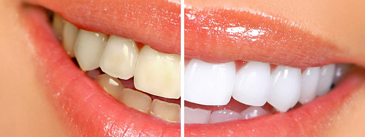 Teeth Whitening Treatment Las Vegas